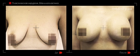 Маммопластика 45 фото до и после процедуры