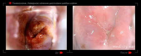 Лазерное лечение дисплазии фото до и после процедуры