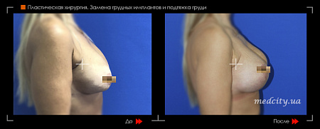 Подтяжка груди фото до и после процедуры