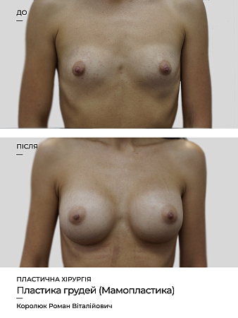 Мамопластика фото до и после процедуры