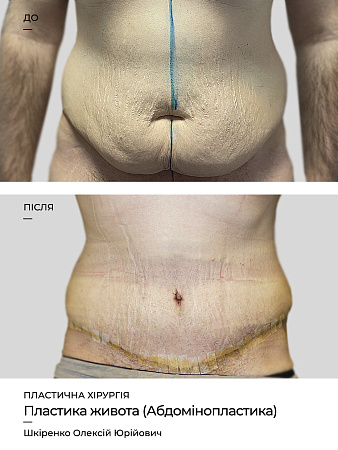 Абдомінопластика фото до и после процедуры