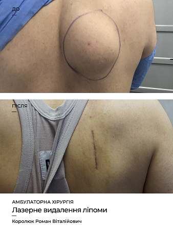 Видалення ліпоми фото до и после процедуры