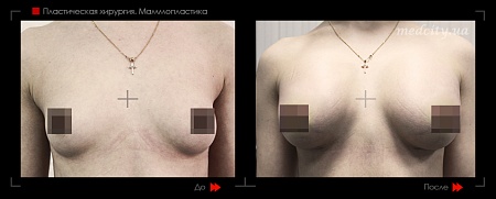 Маммопластика 47 фото до и после процедуры