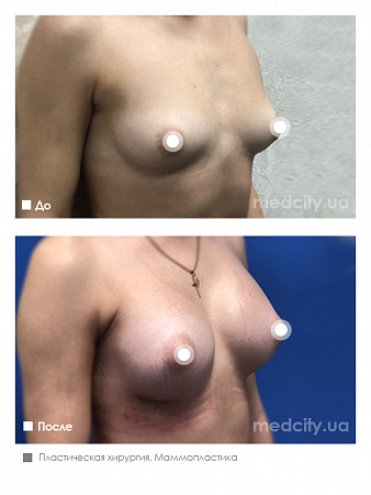 Маммопластика фото до и после процедуры