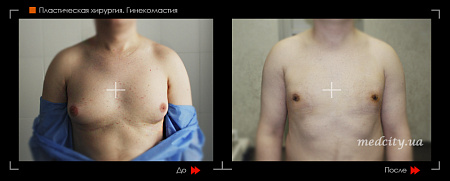 Гинекомастия фото до и после процедуры