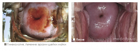 Лазерное лечение эрозии шейки матки фото до и после процедуры