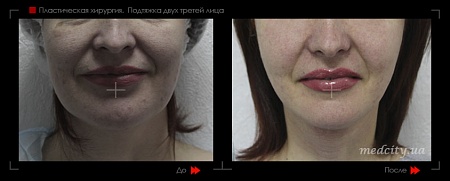 Подтяжка лица 5 фото до и после процедуры