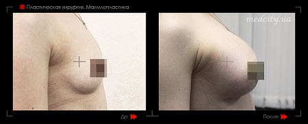 Маммопластика 48 фото до и после процедуры