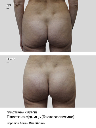 Глютеопластика фото до и после процедуры