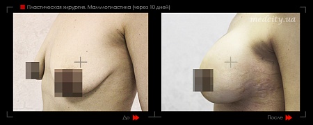 Маммопластика 46 фото до и после процедуры
