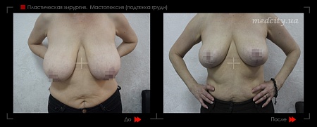 Мастопексия 3 фото до и после процедуры