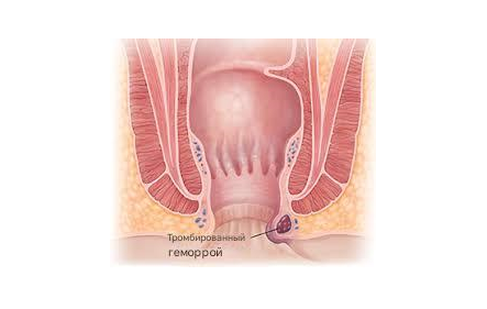 Тромбоз геморроидального узла