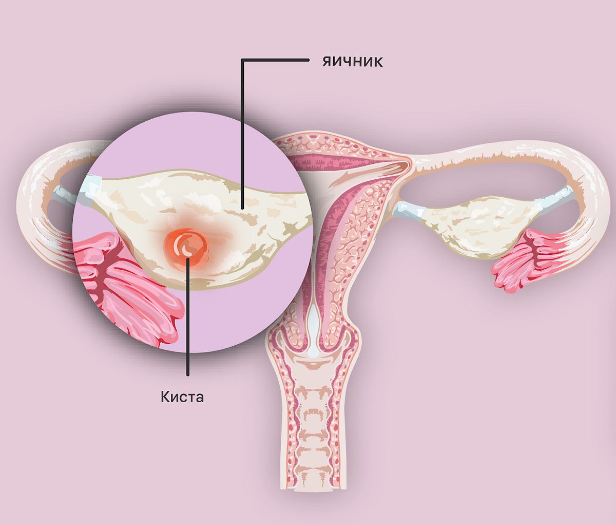 Функциональная киста яичника