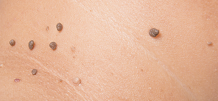 Удаление папиллом лазером