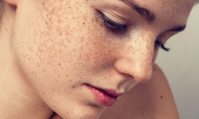 Мелазма: что это, причины заболевания и лечение