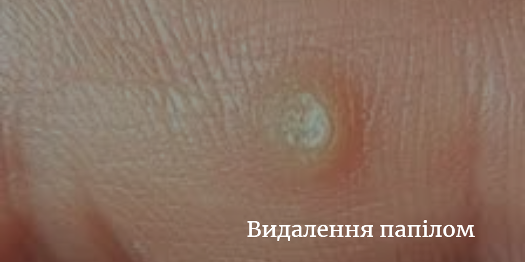 Видалення папілом