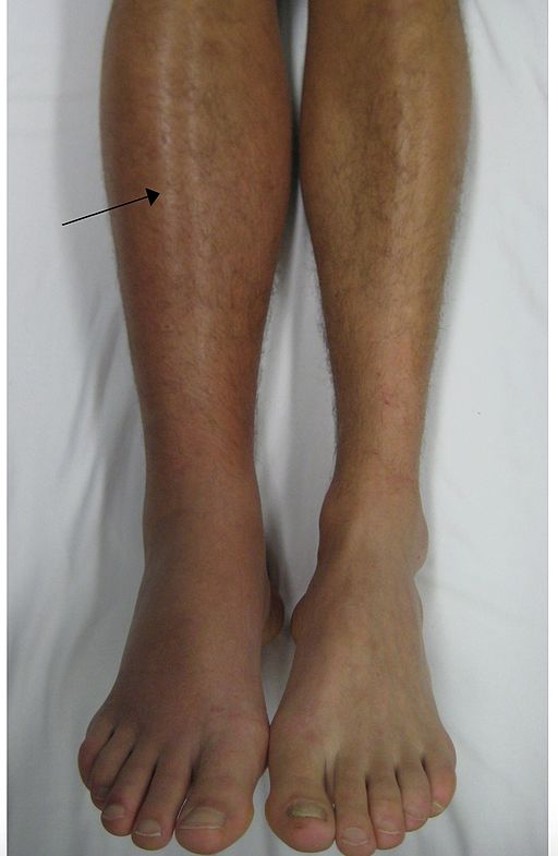 Тромбоз глубоких вен