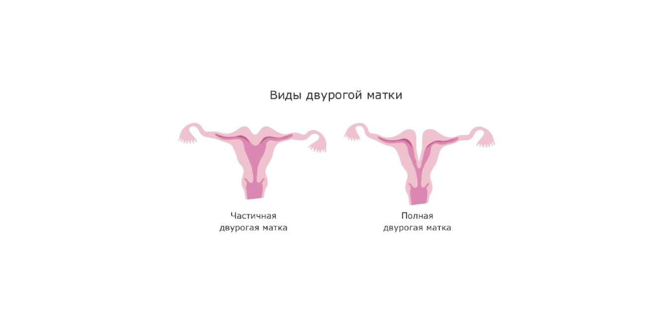 Двурогая матка