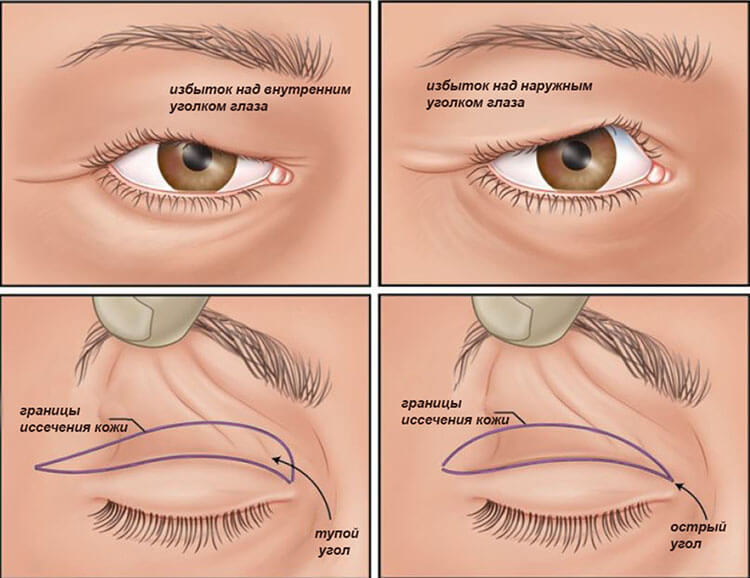 Блефаропластика: сколько раз можно делать пластику век?