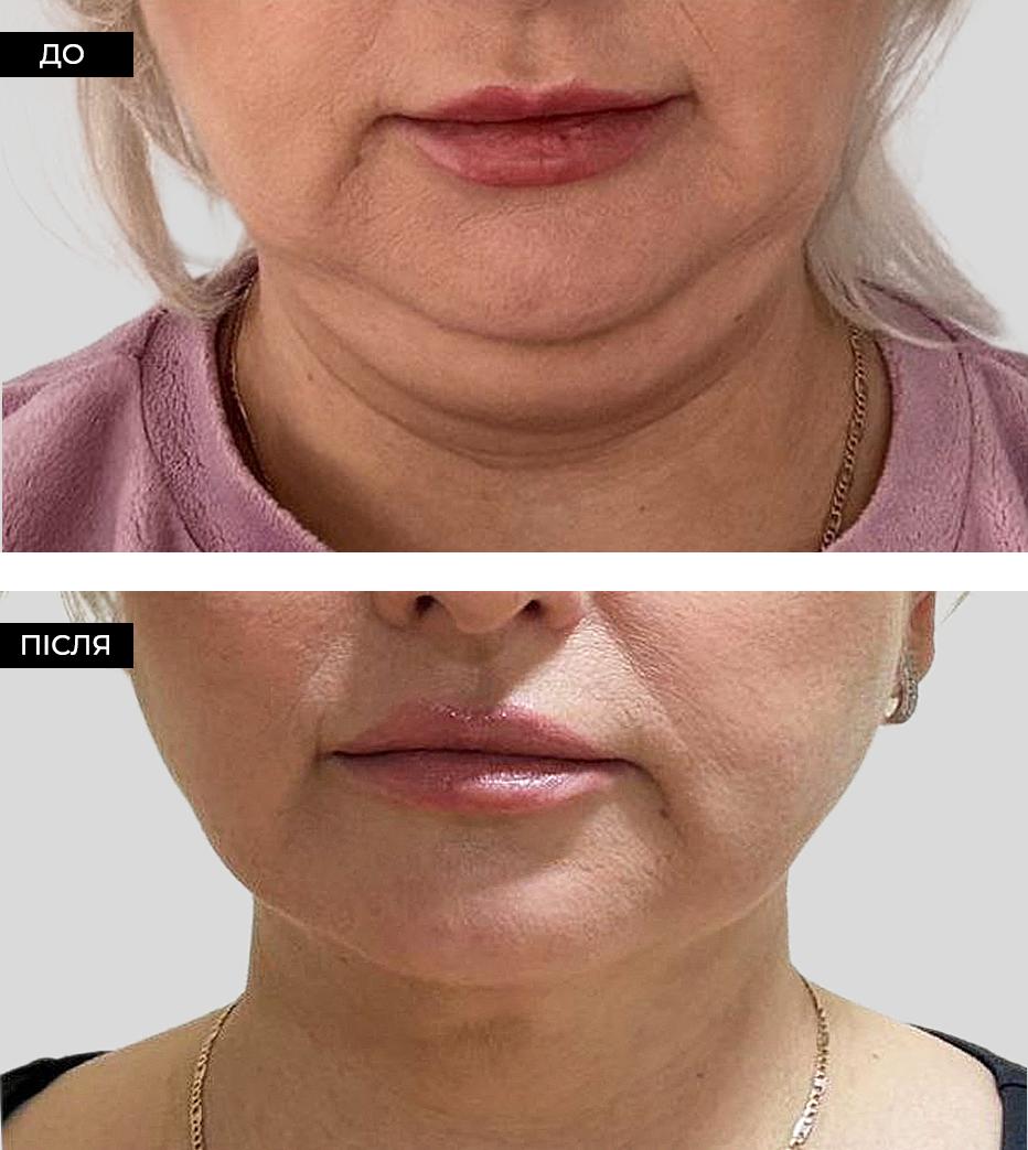 Липосакция подбородка