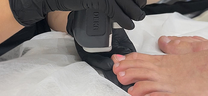 Грибок на ногтях