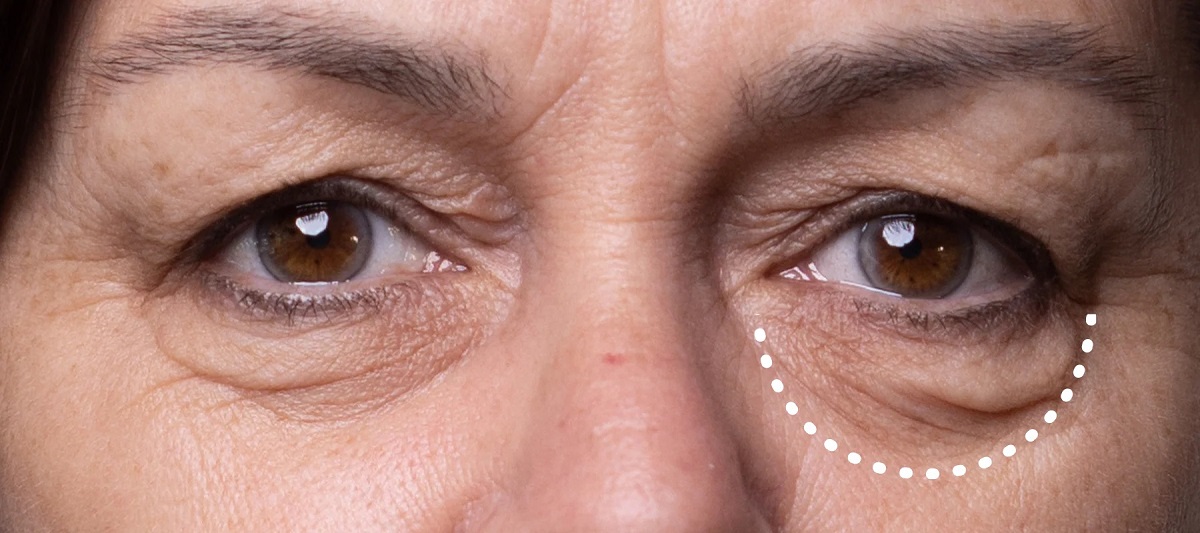 Грыжи под глазами