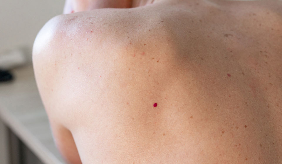 Красные родинки