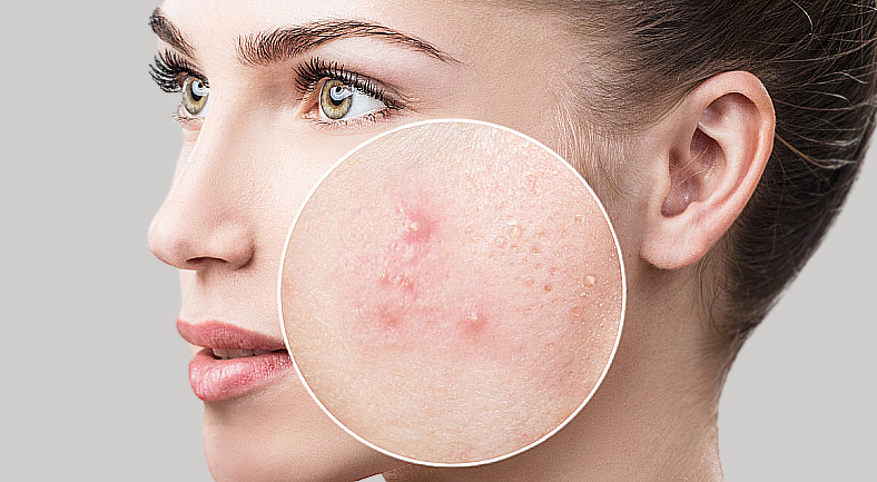 Как вылечить акне?