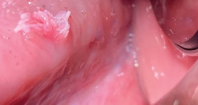 Папиллома влагалища