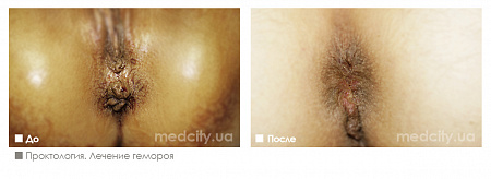 Геморроидэктомия (операция Миллигана-Моргана)