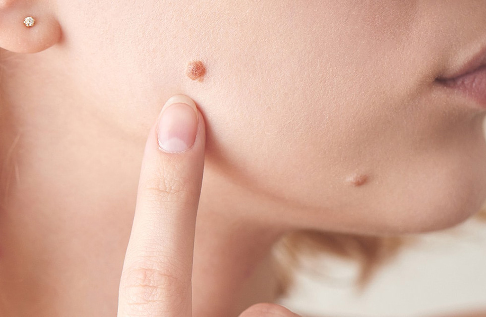 Как избавиться от папиллом?