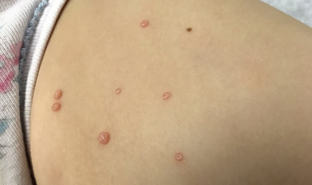 Контагиозный моллюск