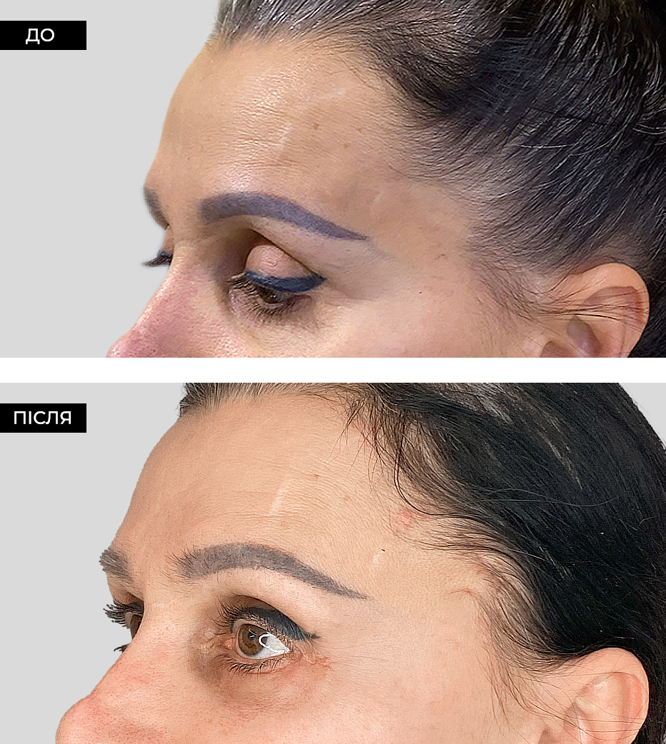 Височный лифтинг