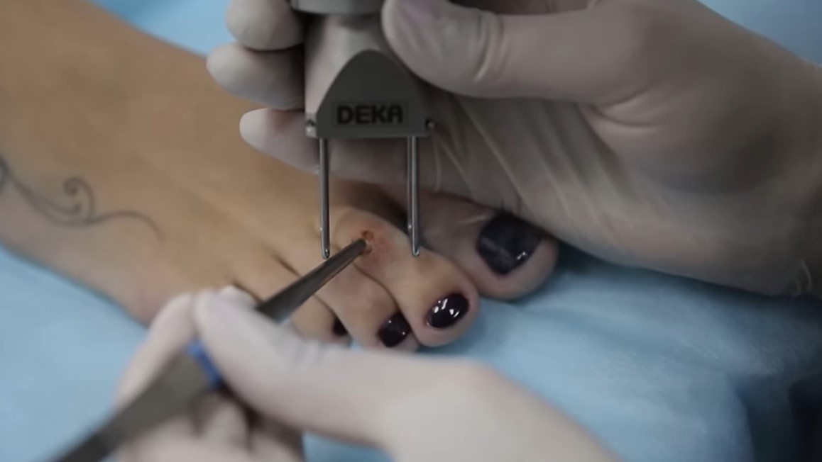 Мозоли на пальцах ног