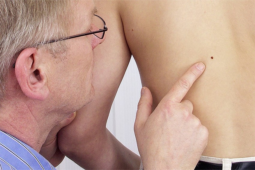 Какие родинки опасны: фото​ и описание