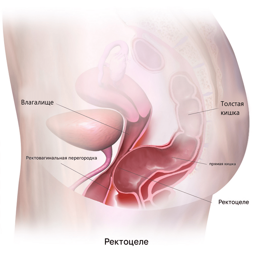 Что такое ректоцеле и как его лечить?