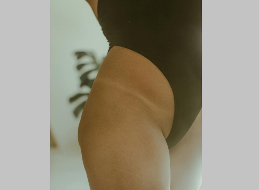 Подтяжка лобка (монспластика)