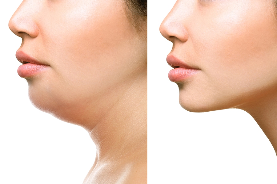 Как убрать второй подбородок