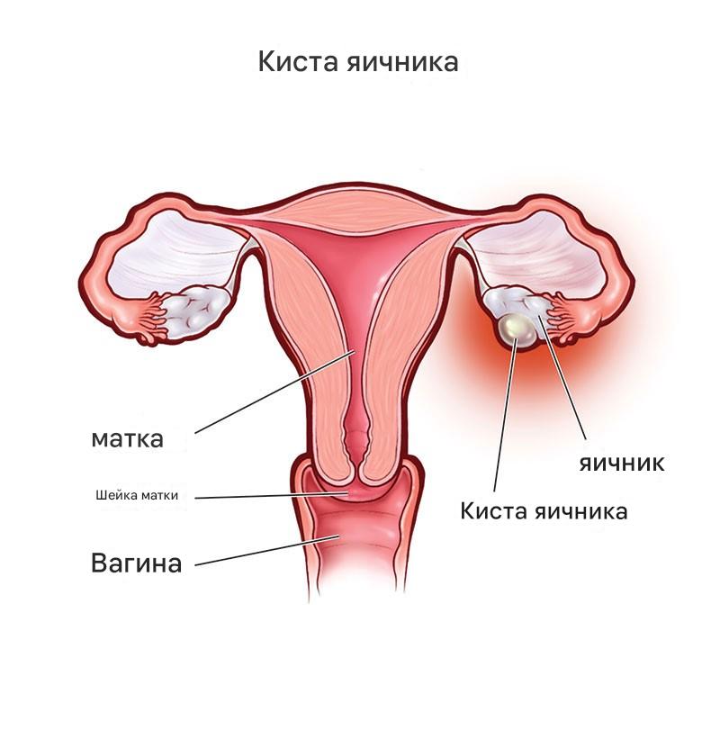 Фолликулярная киста