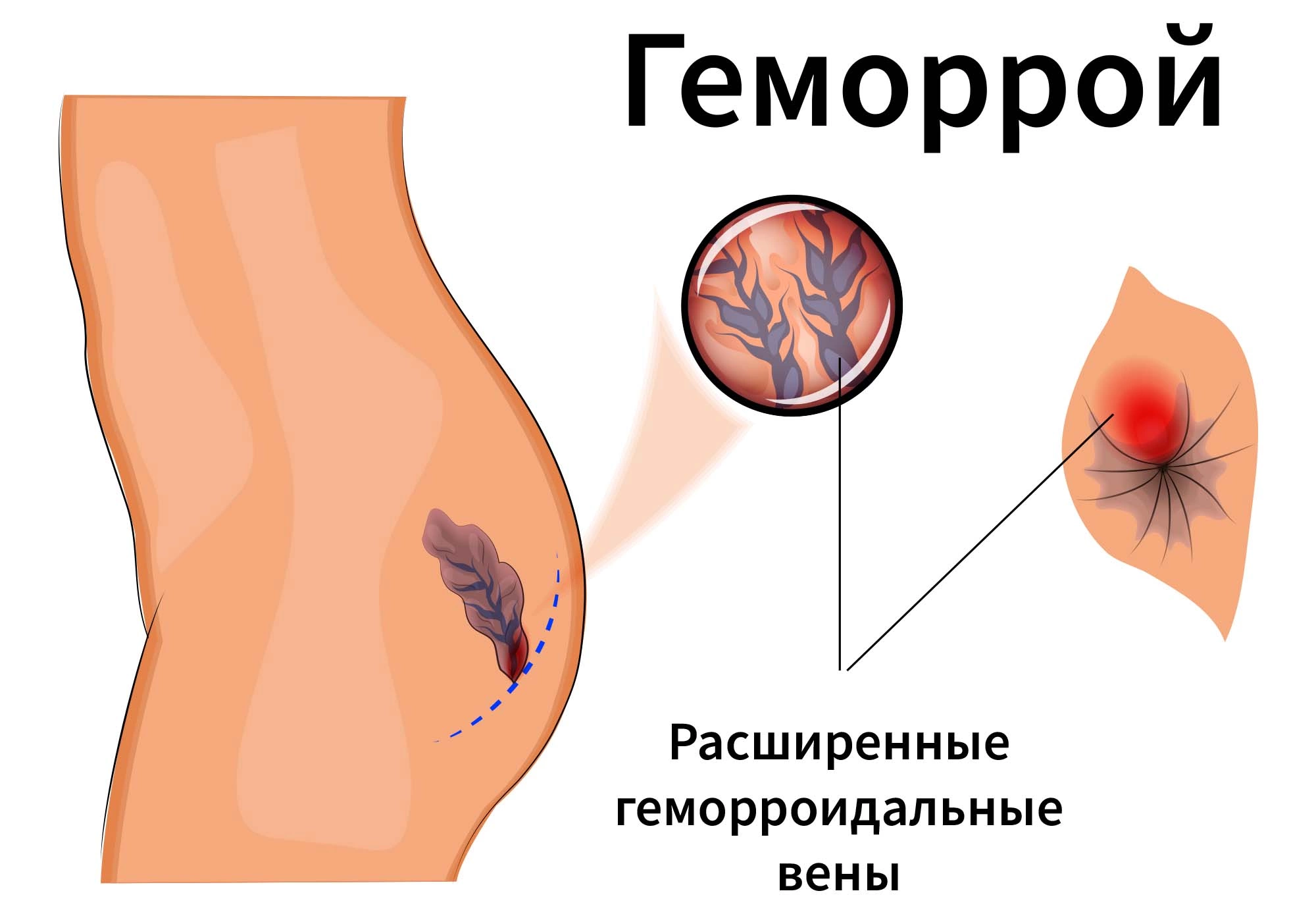 Что делать при геморрое