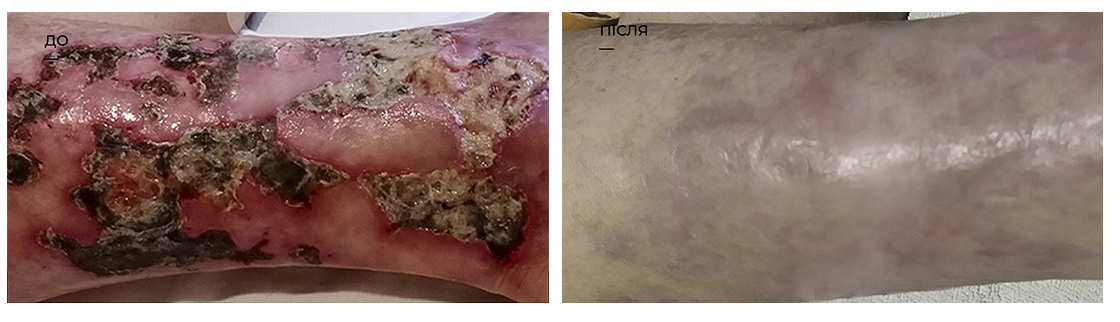 Лечение трофических язв