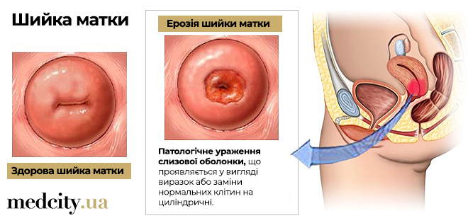 Лечение эрозии шейки матки