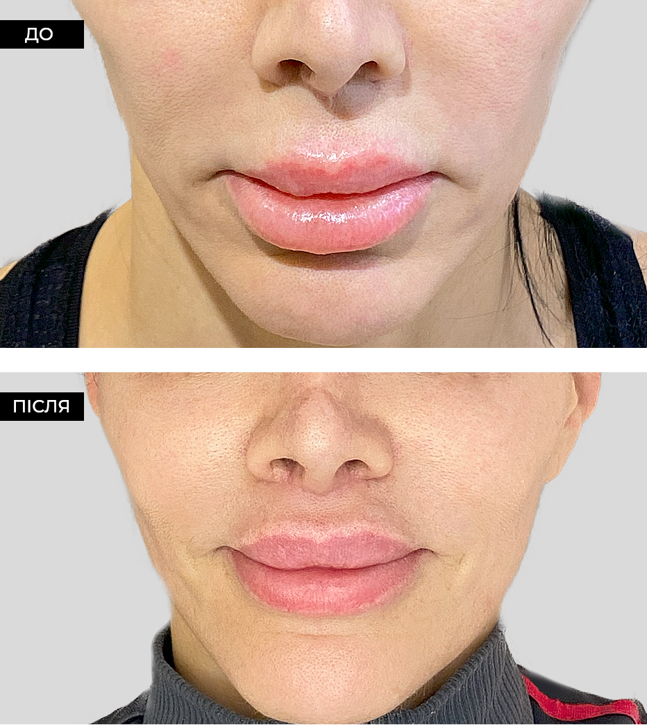 Хейлопластика (пластика губ)