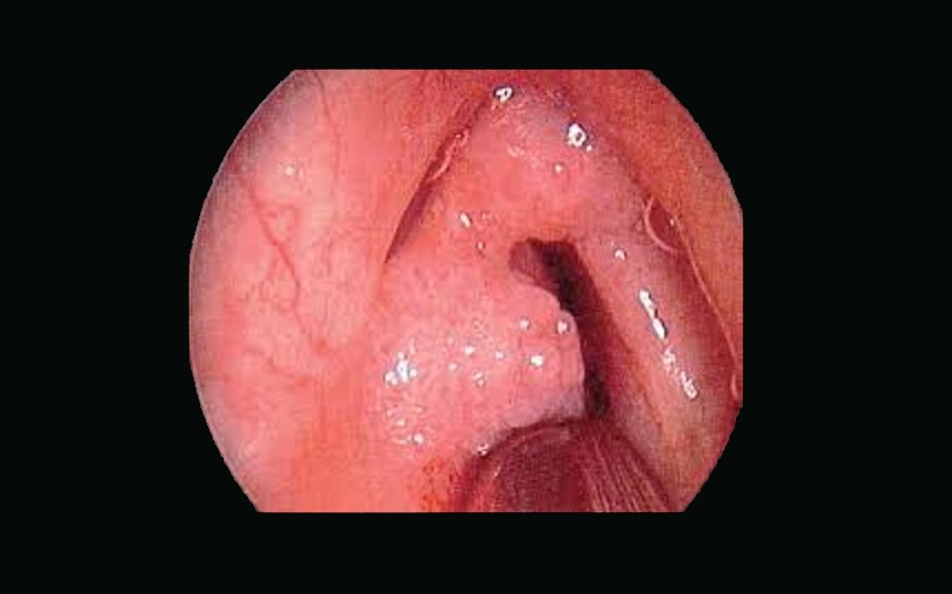 Папилломатоз