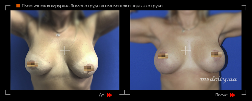 Подтяжка груди с имплантами