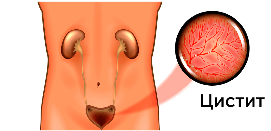 Хронический цистит: симптомы и лечение
