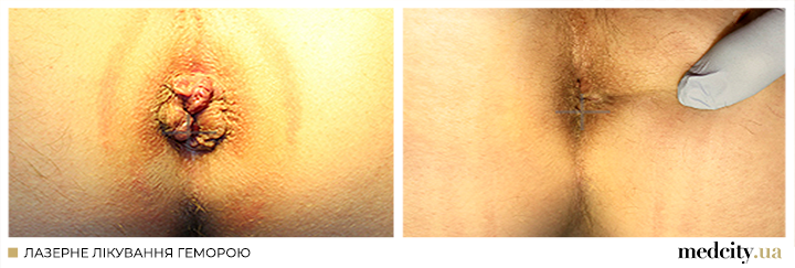 Лазерная вапоризация геморроя