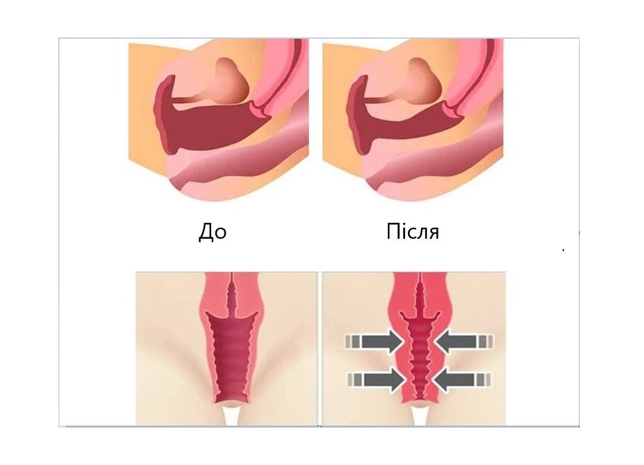 Синдром вагинальной релаксации