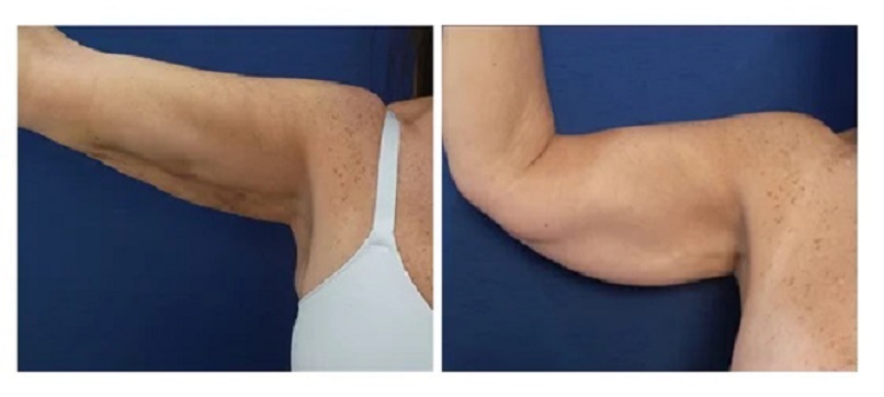 Липосакция рук