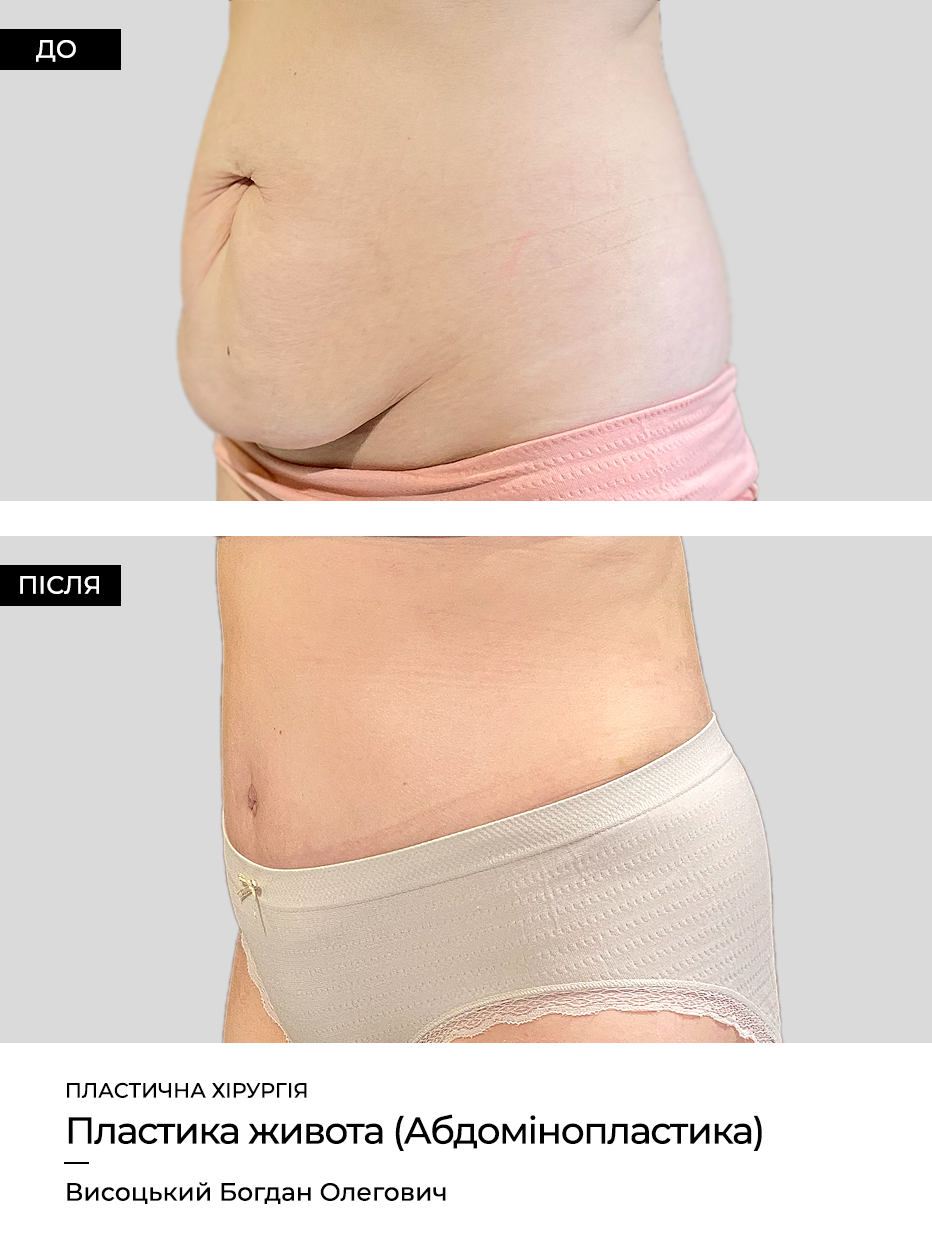 Пластика живота после родов
